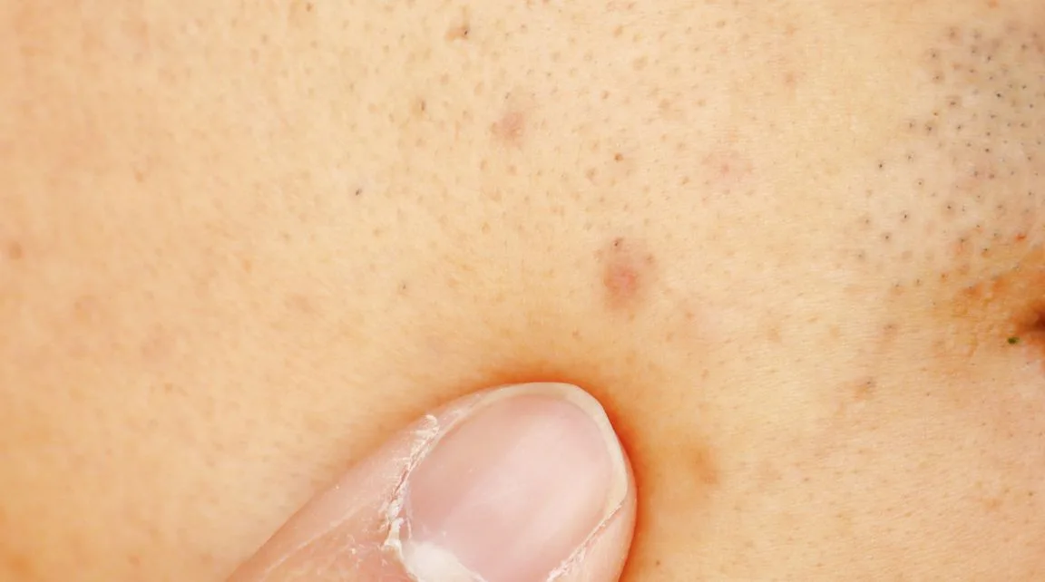 8 sản phẩm giúp bạn trị thâm hiệu quả