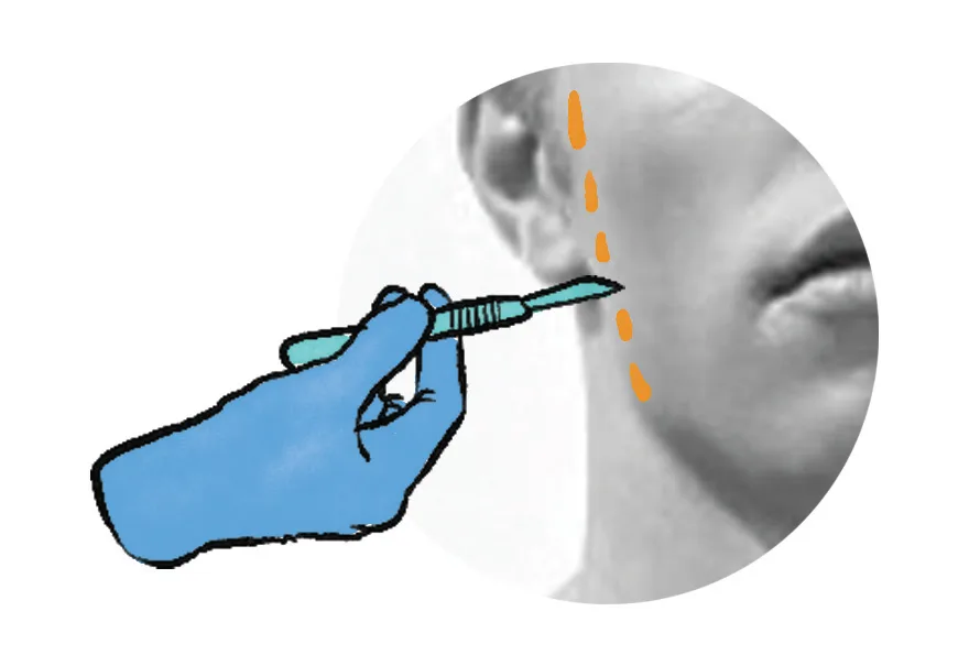 phẫu thuật thẩm mỹ nâng da vùng cổ phẫu thuật thẩm mỹ nâng da vùng cổ