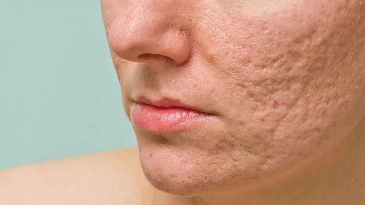 Sẹo mụn và điều bạn cần biết để lấy lại làn da khỏe mạnh
