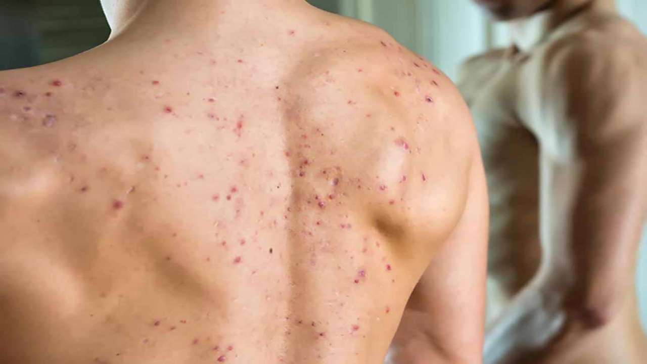 Muốn “đánh bay” mụn lưng thì nên chọn các sản phẩm nào?