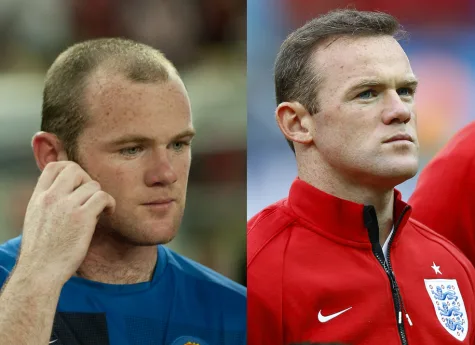 Bên cạnh Rooney, rất nhiều diễn viên tên tuổi khác bao gồm James Nesbitt cũng thay đổi nhờ hair transplant.
