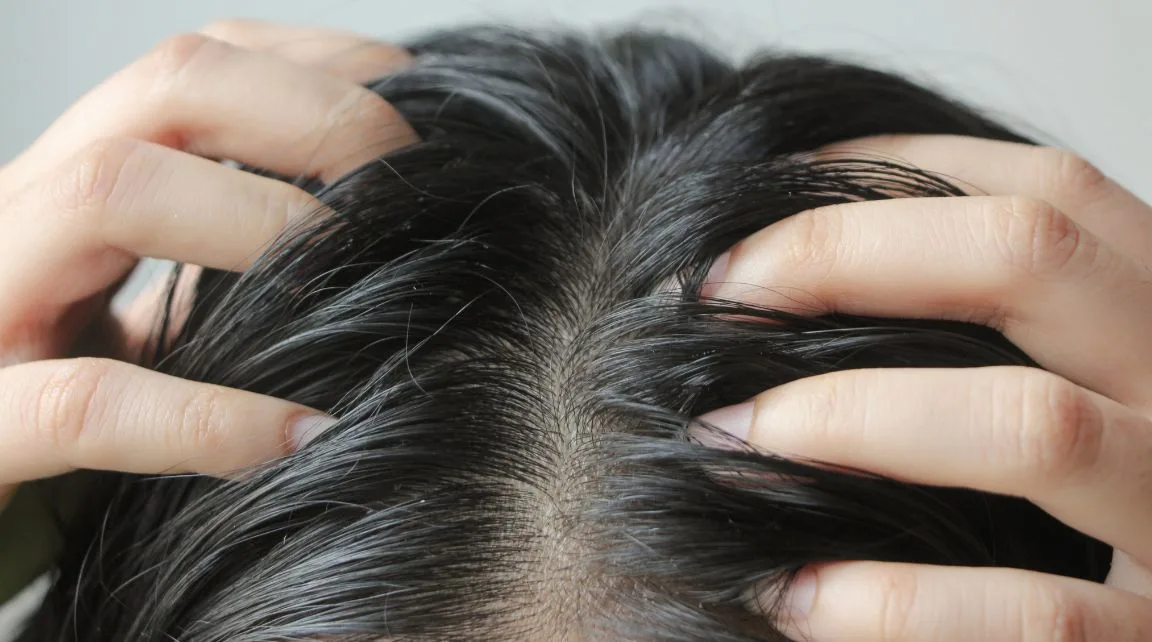 Làm sao hạn chế tình trạng da đầu bị dầu nhờn?